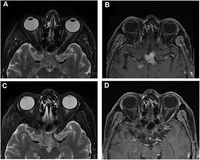 Orbital Magnetic Resonance Imaging May Contribute to the Diagnosis of Optic Nerve Lymphoma